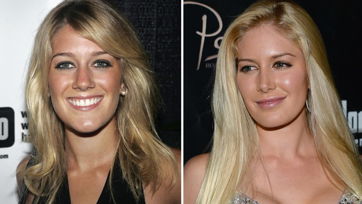 Heidi Montag Heidi Montag vor und nach Schönheits-OP