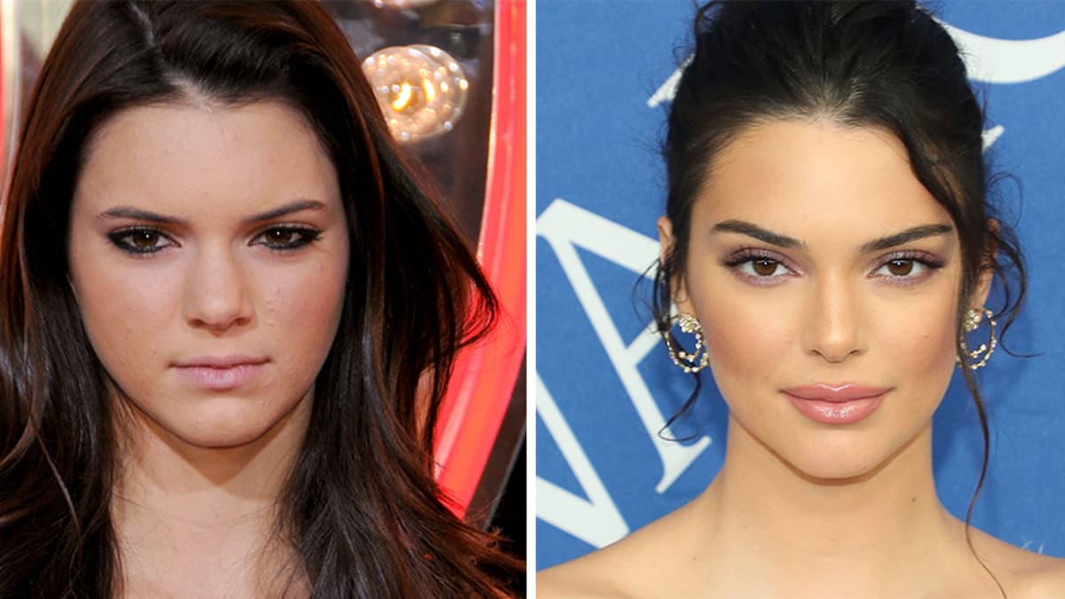 Kendall Jenner Kendall Jenners Gesicht vor und nach OPs