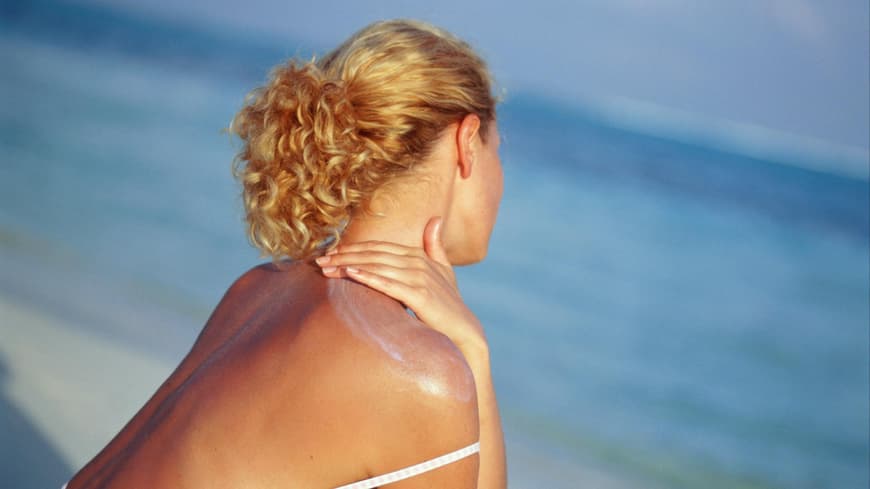 Sonnenbrand richtig behandeln Frau am Strand